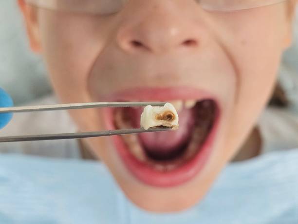 Best Dentist for Tooth Abscess  in Rifle, CO
